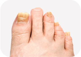 Toenail Fungus
