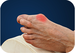 Bunions