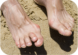 Hammertoes