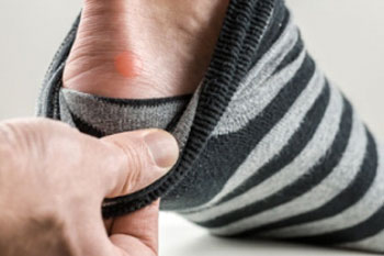 blisters