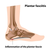 Stretches That May Help to Relieve Pain From Plantar Fasciitis