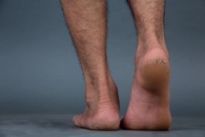 Causes of Dry Cracked Heels